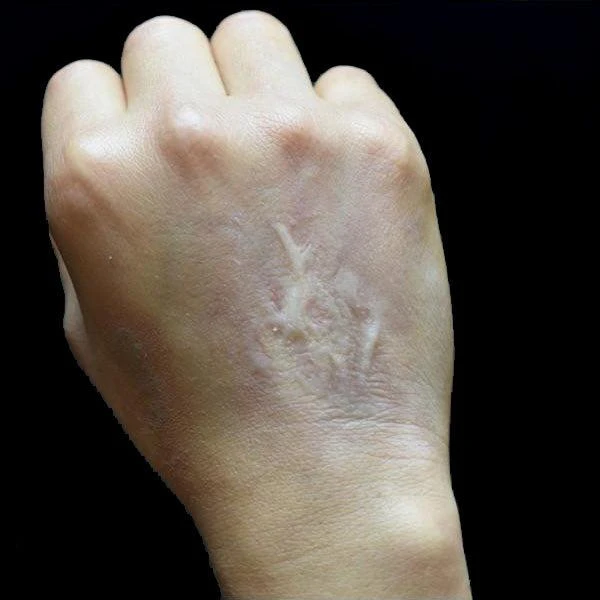 Out Of Kit Healed Burn Scar 1 2 Out Of Kit Healed Burn Scar 1 - Image 2