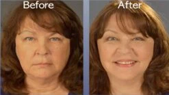 Art Harding Instant Face And Neck Lift 9 Art Harding Instant Face And Neck Lift -Camera Ready Cosmetics ArtHarding BeforeAfter InstantNeckLift