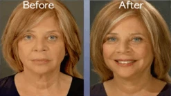 Art Harding Instant Face And Neck Lift 10 Art Harding Instant Face And Neck Lift -Camera Ready Cosmetics ArtHarding BeforeAfter InstantNeckLift 4