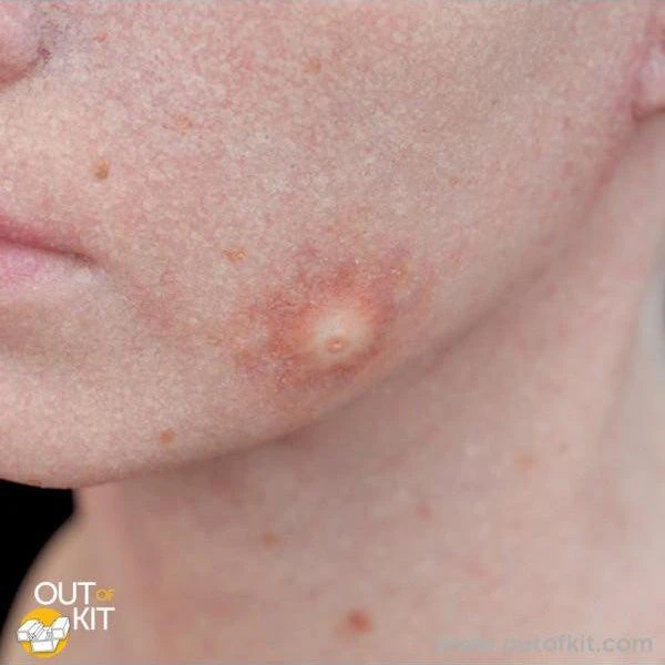 Out Of Kit Insect Bite (Large) 2 Out Of Kit Insect Bite (Large) - Image 2